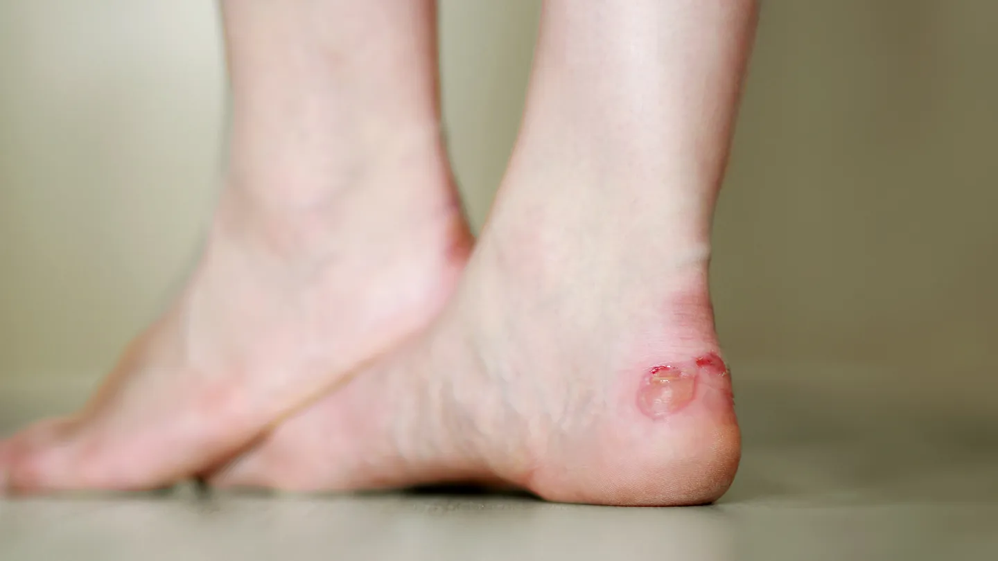 Blaar op uw hand of voet? Dit kunt u doen